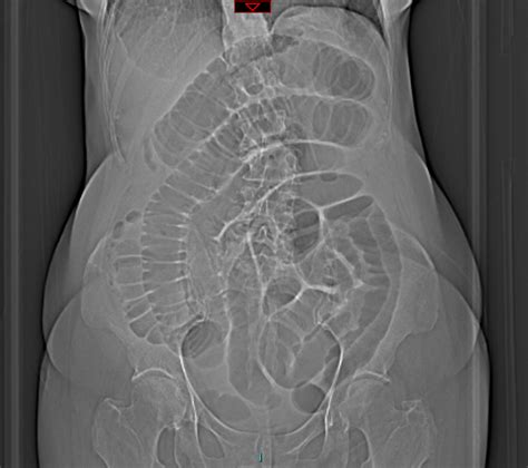 Small Bowel Obstruction | Learn Surgery Online