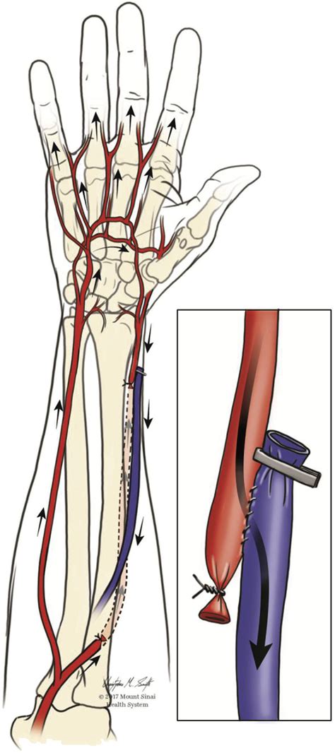 Use Of The Distal Radial Artery Remnant For Autogenous Radial Cephalic