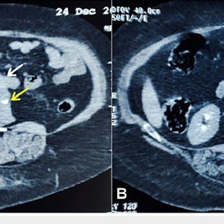 Axial Contrast Enhanced Ct Of The Abdomen Showing A Circumscribed