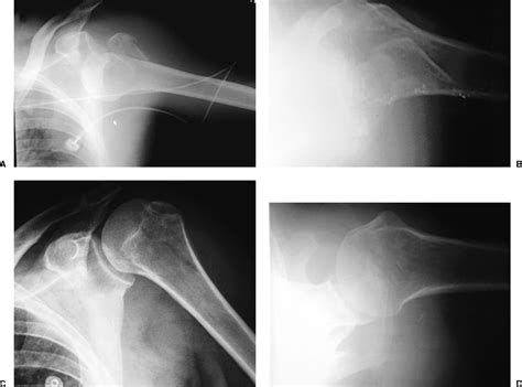 Two Part Fractures And Fracture Dislocations Musculoskeletal Key