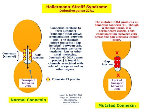 Hallermann-Streiff Syndrome | Hereditary Ocular Diseases