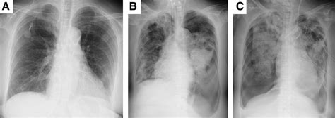 Septic Pulmonary Embolism And Subsequent Bilateral Pneumotho Medicine