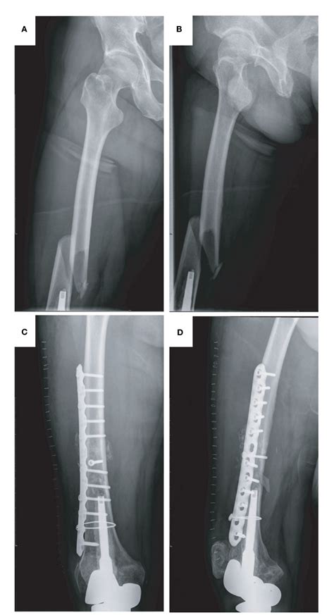 Figure 2 From Revision Surgery For Periprosthetic Fracture Of Distal Femur After Endoprosthetic