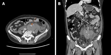 Massive Retroperitoneal Hematoma As An Acute Complication Of Retrograde