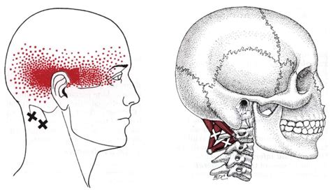 Obliquus Capitis Inferior - Physiopedia