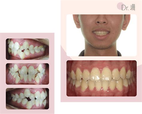 青少年兒童 隱適美 隱形矯正 Invisalign For Teens Dr珊｜台中推薦牙醫