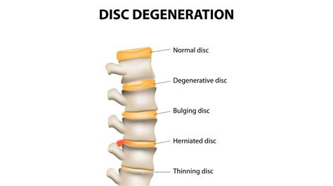 Herniated Disc Program At Cram Osteopaths Glasgow