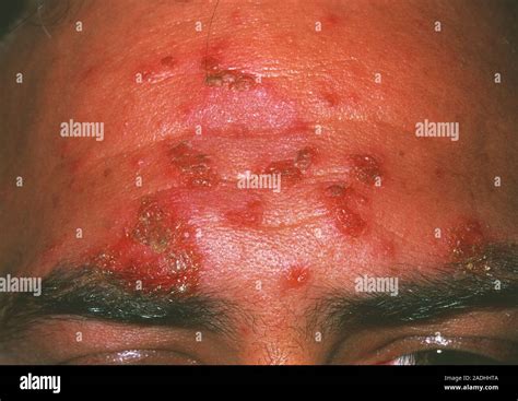 Impetigo Infection On The Forehead Of A 35 Year Old Man Impetigo Is A