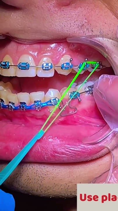 Rubber Bands Class 3 Elastics Orthodontics Youtube