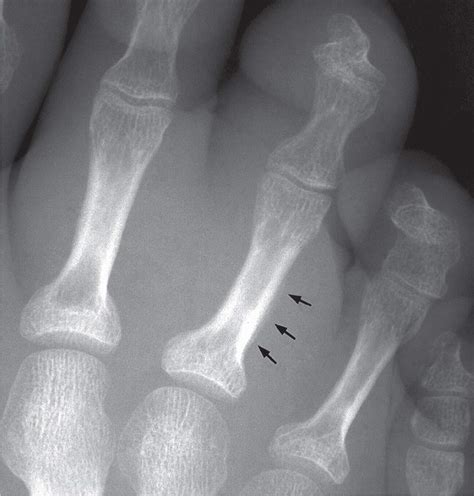 18 Bone Infection Musculoskeletal Key