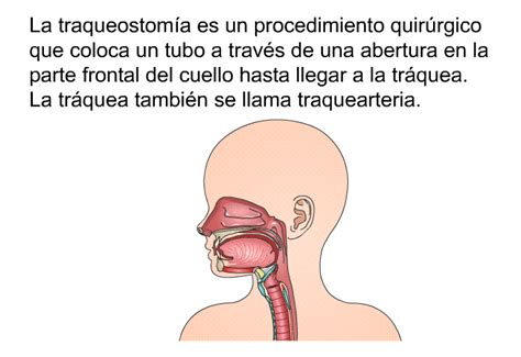 PatEdu Cuidados de la traqueostomía Pediatría