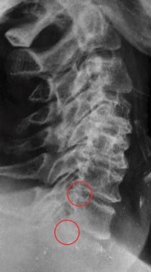 Lateral Radiological Feature Of A Patient Having Cervical Radiculopathy