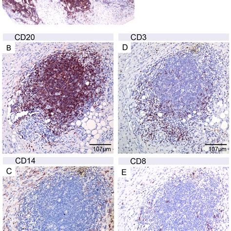 Presence Of B Cell Clusters In The Secondary Lesions A Band Of CD20