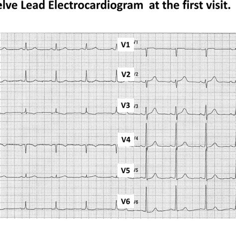 Electrocardiogram ECG At The First Visit The ECG Showed A Sinus