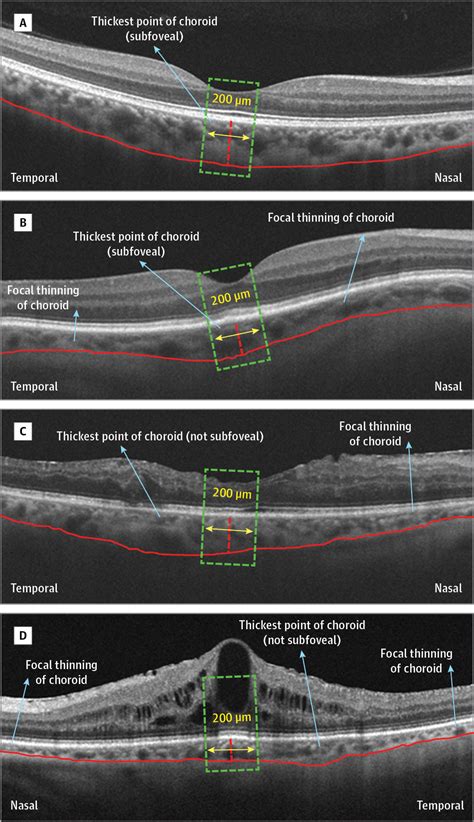 Analysis Of Morphological Features And Vascular Layers Of Choroid In