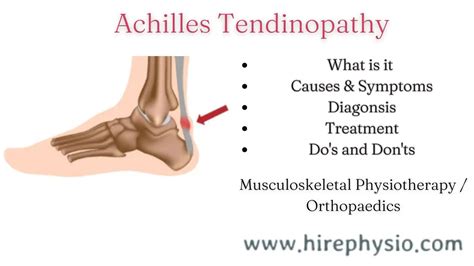 3 Way - Effective Treatment Options For ACHILLES TENDINITIS Or ACHILLES TENDINOPATHY : Get Quick ...