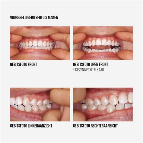 Online Invisalign Consult Ortho Billet