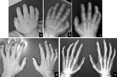 Phenotype And Genotype In Mucolipidoses II And III Alpha Beta A Study