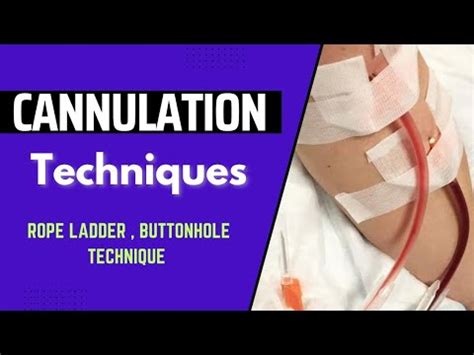 The Essential Guide To Dialysis Cannulation Youtube