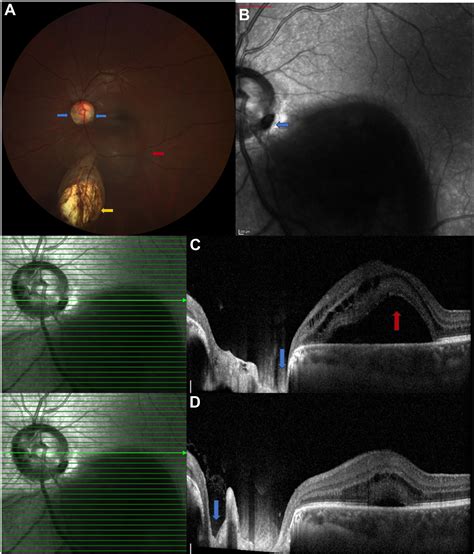 Dual Optic Disc Pit With Maculopathy Ophthalmology Retina