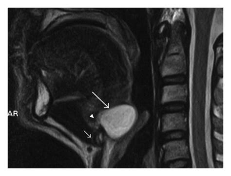 A Sagittal T1 Weighted Tr Te 585 10 B Sagittal T2 Weighted