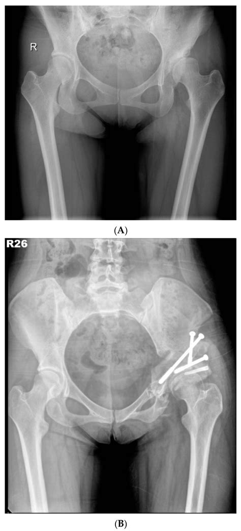 A Preoperative Anteroposterior Standing Radiograph Of A 26 Year Old