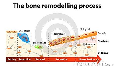 Bone Remodelling Process Stock Vector - Image: 61582324