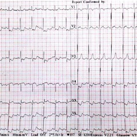 Electrocardiogram At Presentation Showing Sinus Tachycardia Heart Rate