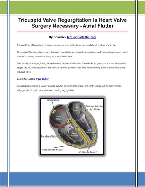 Tricuspid valve regurgitation is heart valve surgery necessary