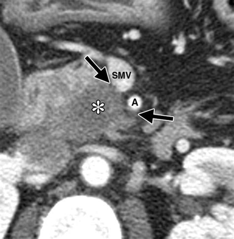 Intraoperative Ultrasonography Of The Pancreas Radiographics