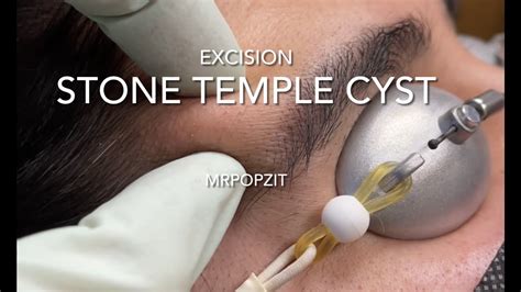 Stone Temple Cyst Tug Of War Large Calcified Cyst On Temple Excision