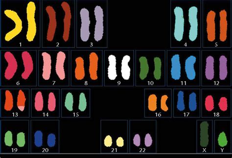 Figure 3 From Prenatal Diagnosis And Molecular Cytogenetic Characterization Of De Novo Partial