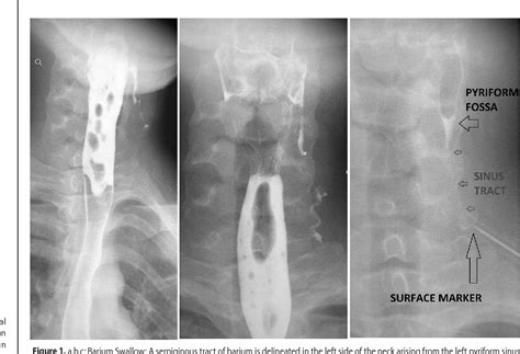 Figure 1 from Pyriform sinus fistula. | Semantic Scholar