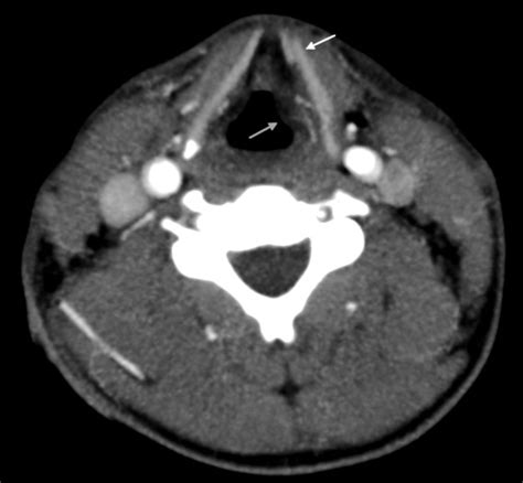 Early Recognition And Management Of Laryngeal Fracture A Case Report Ochsner Journal