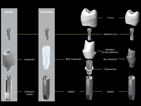 Types of Abutment