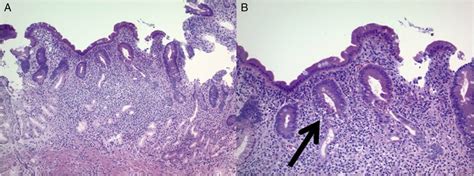 Duodenal Biopsies Reveal Villous Blunting And Expansion Of The Lamina