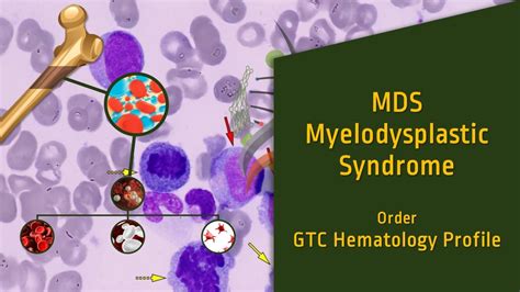 Myelodysplastic Syndrome