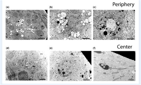 Transmission Electron Microscopy Of Testicular Tissues From A Patient