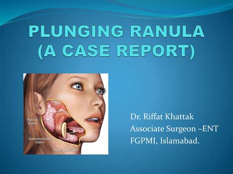 Plunging Ranula A Case Reportdeep Diving Or A Cervical Ranula Ppt