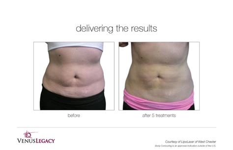 Venus Body Contouring Skin Tightening Deja Vu Med Spa