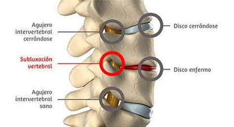 Dolor Lumbar Y Sindrome Facetario