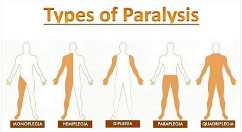 [Infographic] Types of Paralysis | Paralysis, Medical facts, Nursing books