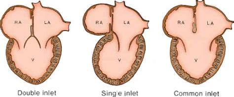 Univentricular Atrioventricular Connection Thoracic Key