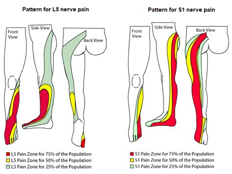 Want to avoid surgery for an L4-5 or L5-S1 herniated disc?