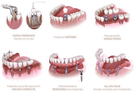 Tipos De Implantes Dentales Junyent Estudi Dental Manresa