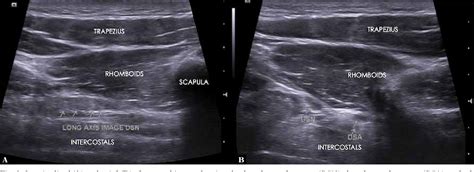 Figure 1 From Dorsal Scapular Nerve Entrapment Neuropathy Managed By Ultrasound Guided