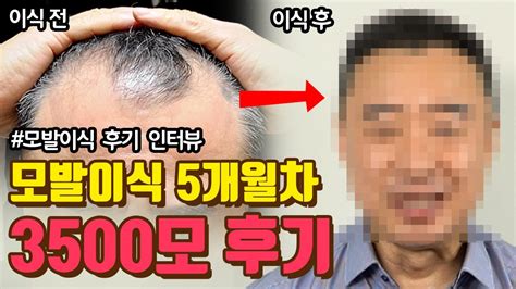 모발이식 후기 성공한 내 탈모 여정과 자신감 회복의 비밀 클릭하면 모발 재생의 신기한 변화를 확인하세요