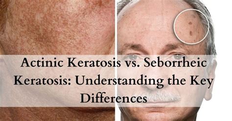 Actinic Keratosis vs Seborrheic Keratosis