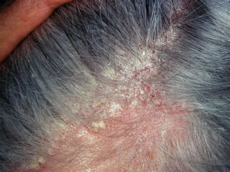 Mild Scalp Dermatitis