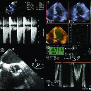 A D Echocardiography Transthoracic Echocardiogram Performed After